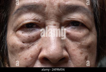 Kleine braune Flecken, die man Altersflecken nennt, auf dem Gesicht der älteren asiatischen Frau. Sie werden auch als Leberflecken, senile Lentigo oder Sonnenflecken bezeichnet. Nahaufnahme. Stockfoto