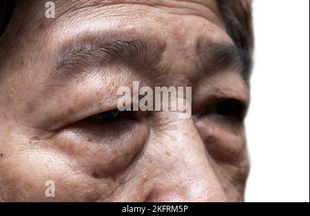 Prominenter Fettbeutel unter den Augen der älteren asiatischen Frau. Nahaufnahme. Stockfoto