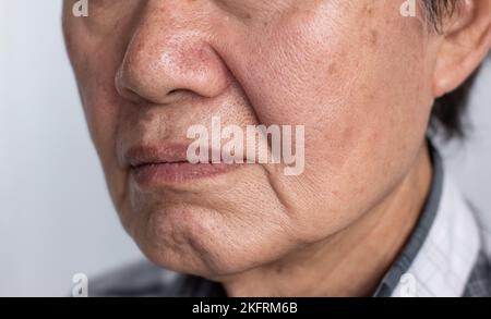 Vergrößerte Poren im Gesicht des südostasiatischen, chinesischen älteren Mannes mit Hautfalten. Stockfoto