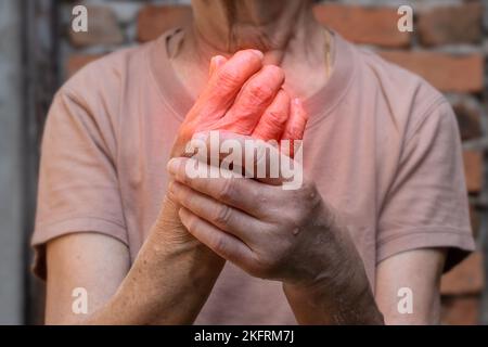 Entzündung der Handgelenke. Konzept und Idee von rheumatischer Arthritis, Rheuma, Gicht, Gelenkschwellung oder Arthralgie. Stockfoto