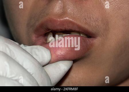 Geschwollene oder verdickte Lippe eines jungen asiatischen Mannes. Angioödem. Ursachen können Allergien, Infektionen, Verletzungen usw. sein Stockfoto