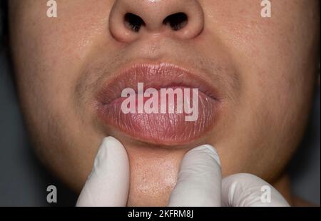 Geschwollene oder verdickte Lippe eines jungen asiatischen Mannes. Angioödem. Ursachen können Allergien, Infektionen, Verletzungen usw. sein Stockfoto