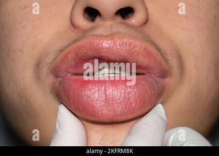 Geschwollene oder verdickte Lippen eines jungen asiatischen Mannes. Angioödem. Komplikationen bei der Injektion von Füllstoffen. Ursachen können Allergien, Infektionen, Verletzungen usw. sein Stockfoto