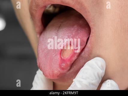 Geschwulst an der Zunge eines männlichen asiatischen Patienten. Die Diagnose kann aphtöses Geschwulst, Halsschmerzen, Stressulkus oder Zungenkrebs sein. Stockfoto