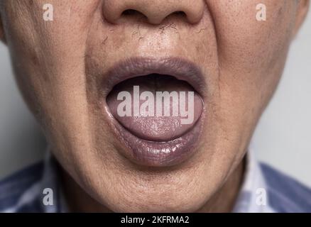 Zentrale Zyanose bei einem alten Mann aus Südostasien mit angeborenem Herzfehler. Stockfoto