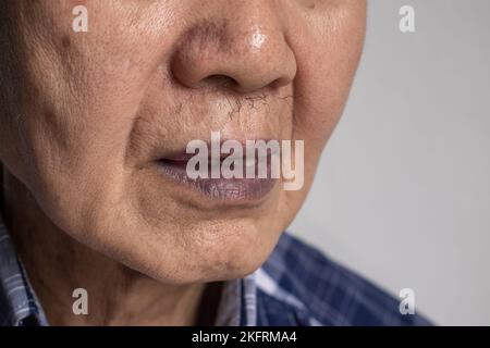 Zentrale Zyanose bei einem alten Mann aus Südostasien mit angeborenem Herzfehler. Stockfoto