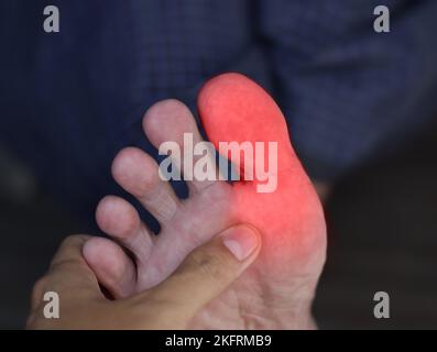 Entzündung im großen Zeh des asiatischen Mannes. Konzept von Fußgelenkschmerzen, Arthritis, Stolpern, Hyperurizem oder Gicht. Stockfoto