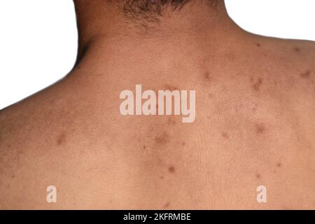 Schwarze Flecken und Narben auf dem Rücken des asiatischen Mannes aus Myanmar Stockfoto