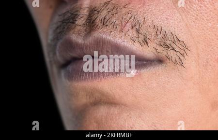 Zentrale Zyanose bei einem jungen Mann aus Südostasien mit angeborenem Herzfehler. Stockfoto