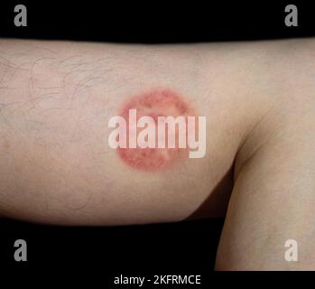 Pilzinfektion genannt Tinea corporis in Südostasien Mann. Ringwurm Stockfoto