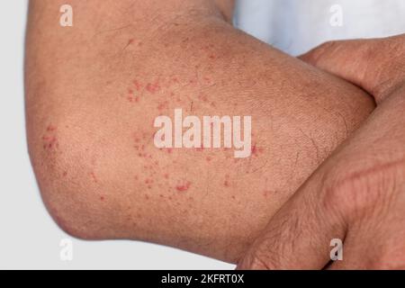 Mehrere juckende Moskitos oder Insektenbiss-Keuchen; rote Flecken auf dem Unterarm des erwachsenen Mannes aus Südostasien. Stockfoto