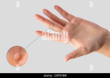 Warze am Finger. Nahaufnahme einer Warze am Finger eines Kindes. Die gewöhnliche Warze Verruca vulgaris wird durch eine Art humanes Papillomavirus, HPV, verursacht. Stockfoto