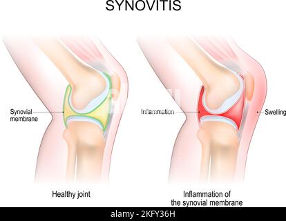 Synovitis eines Kniels. Nahaufnahme des normalen Gelenks und des Knies mit Entzündung der Synovialmembran. Anzeichen und Symptome der Krankheit. Seitenansicht Stock Vektor