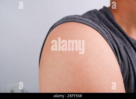 Monkeypox- und Pockenimpfstoff-Narbe auf der menschlichen Schulter der Patenz Stockfoto