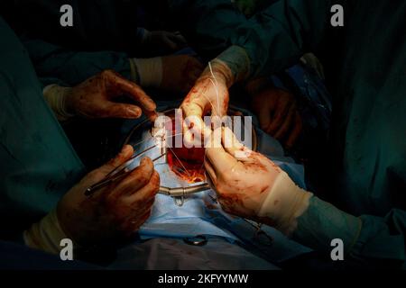 Aufgrund einer Fehlfunktion der Herzklappe führt der Arzt eine Operation am offenen Herzen durch, um die Herzklappe im Operationssaal zu ersetzen Stockfoto