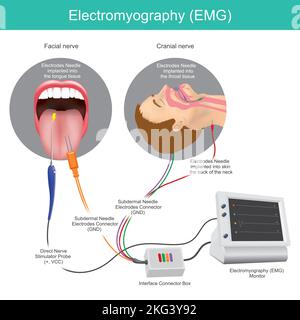 Elektromyographie. Eine medizinische Technik zur Beurteilung und Aufzeichnung der elektrischen Aktivität, die von Muskeln erzeugt wird. Stock Vektor