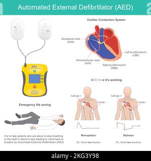 Automatisierter Externer Defibrillator. Es handelt sich um ein elektronisches Gerät zur Lebenserhaltungs-Unterstützung, das Kammerflimmern und andere Dysrhythmien erkennt und liefert Stock Vektor