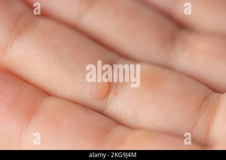 Warze am Finger. Nahaufnahme einer Warze am Finger eines Kindes. Die gewöhnliche Warze Verruca vulgaris wird durch eine Art humanes Papillomavirus, HPV, verursacht. Stockfoto