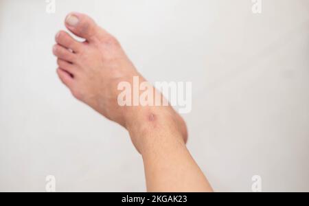 Nahaufnahme des weiblichen Fußes mit trockener, gerissener Haut an der Nagelhaut, gerissener Haut und abblätternder Haut zur Reparatur mit der Feuchtigkeitscreme behandeln. Stockfoto