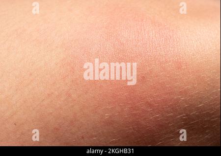 Allergie auf den menschlichen Körper und Rötung durch Wespenstich, Rötung und Stich aus der Nähe. Stockfoto