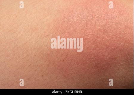 Allergie auf den menschlichen Körper und Rötung durch Wespenstich, Rötung und Stich aus der Nähe. Stockfoto