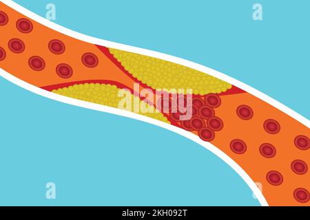 Die Blutgefäße werden durch zusätzliches Körperfett blockiert. Rote Blutkörperchen sind durch gelbes Fett in einer Arterie blockiert. Menschliche Anatomie und Blutgerinnung Stock Vektor