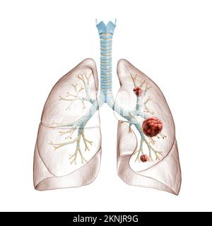 Lungenkrebs oder Karzinom 3D-Darstellung. Bronchialbaum und Lunge mit Krebszellen auf weißem Hintergrund infiziert. Medizin, Gesundheitswesen, Oncolo Stockfoto