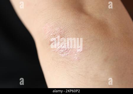 Psoriasisplaques am Ellenbogen eines Patienten mit Hautkrankheit Closeup Stockfoto