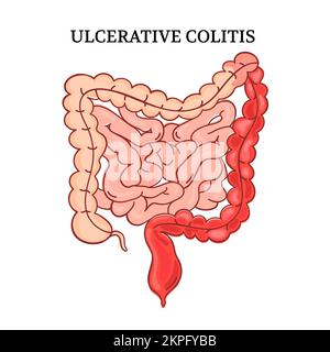 COLITIS ULCEROSA Darm Bildung Anatomie des menschlichen medizinischen Schemas handgezeichnet mit Text Vektor Illustration Set for Print Stock Vektor