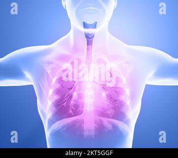 Menschliche Anatomie, Probleme mit dem Atmungssystem, schwer geschädigte Lungen. Bilaterale Pneumonie. Covid-19, Coronavirus. Patient und Rauch. Raucher Stockfoto