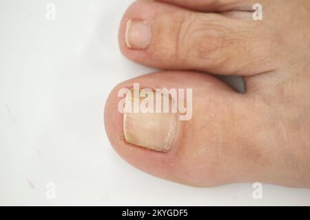 Big-Toe-Nagel einer Person, die an Onychomykose, einer Pilzinfektion, die Gelbfärbung des Nagels verursacht leidet Stockfoto