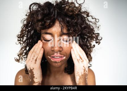 Porträt einer jungen Frau mit Vitiligo-Krankheit streichelt seine Haut. Nahaufnahme einer attraktiven jungen Frau mit Hautstörung. Stockfoto