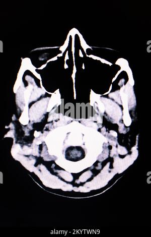 Bild der Computertomographie des Gehirns aus nächster Nähe Stockfoto