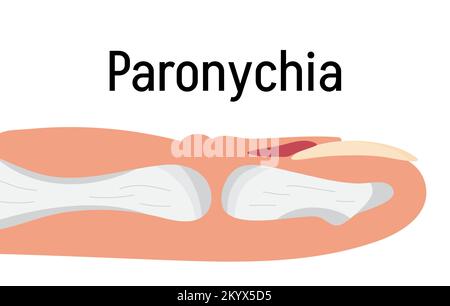 Paronychia konzepnt Vektor für medizinischen Blog, App, Banner. Nagelentzündung, die durch Trauma, Reizung oder Infektion hervorgerufen werden kann. Stock Vektor