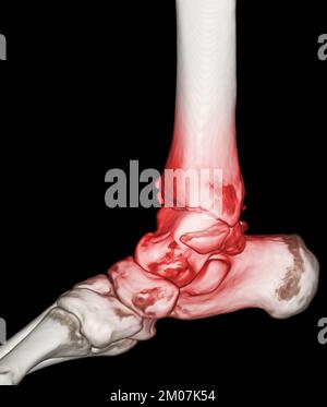 CT-Scan Knöchel und Fuß oder Computertomographie des Sprunggelenks und Fußes 3Drendering-Bild mit frakturierter Tibia und Fibula. Stockfoto