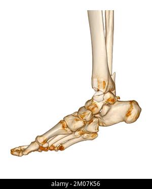 CT-Scan Knöchel und Fuß oder Computertomographie des Sprunggelenks und Fußes 3Drendering-Bild mit frakturierter Tibia und Fibula. Stockfoto