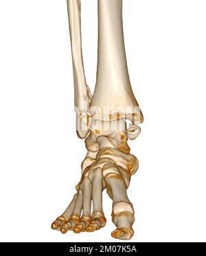 CT-Scan Knöchel und Fuß oder Computertomographie des Sprunggelenks und Fußes 3Drendering-Bild mit frakturierter Tibia und Fibula. Stockfoto