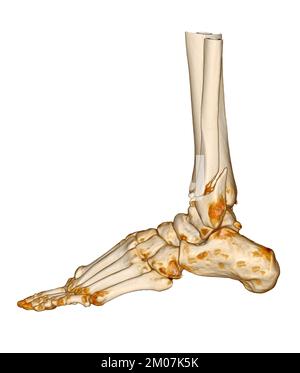 CT-Scan Knöchel und Fuß oder Computertomographie des Sprunggelenks und Fußes 3Drendering-Bild mit frakturierter Tibia und Fibula. Stockfoto