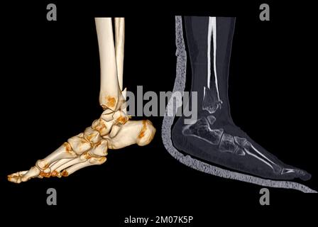 CT-Scan Knöchel und Fuß oder Computertomographie des Sprunggelenks und Fußes 3Drendering-Bild mit frakturierter Tibia und Fibula. Stockfoto