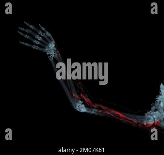 Armarterien mit Knochen-3D-Rendering der oberen Extremität vom CT-Scanner. Stockfoto