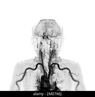 Armarterien mit Knochen-3D-Rendering der oberen Extremität vom CT-Scanner. Stockfoto