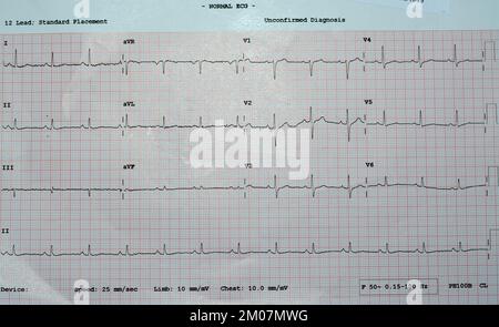 Ein EKG, ein Diagramm, das die Elektrizität des Herzens zieht und eine Vorstellung von der Herzerkrankung und dem Rhythmus gibt und alle ausschließt Stockfoto