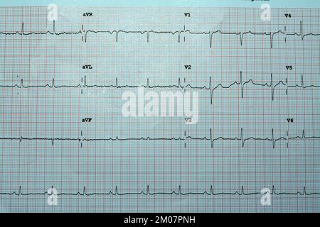 Ein EKG, ein Diagramm, das die Elektrizität des Herzens zieht und eine Vorstellung von der Herzerkrankung und dem Rhythmus gibt und alle ausschließt Stockfoto