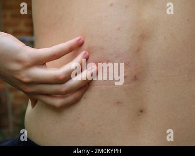 Der Rücken eines jungen Mannes oder Teenagers bedeckt mit juckenden roten Entzündungen und eine Hand, die nach ihnen greift, Akne auf der Haut während der Pubertät Stockfoto