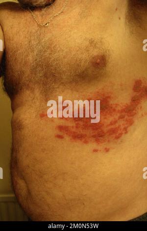 Der schmerzhafte rote Blasenausschlag von Gürtelrose, Herpes Zoster. Stockfoto