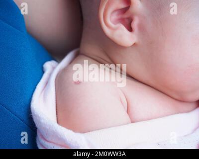 Impfreaktion von Bacillus Calmette Guerin BCG-Impfstoff auf die Neugeborenenschulter, gegen Tuberkulose eingesetzt Stockfoto