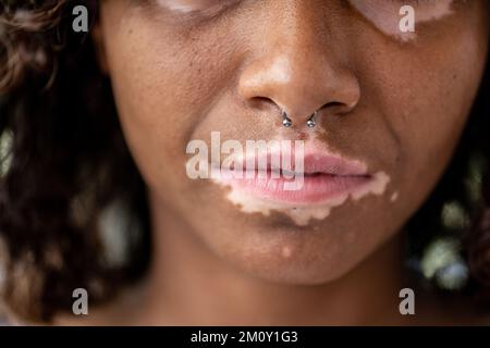 Porträt einer jungen brasilianischen Frau mit Vitiligo auf Gesicht und Lippen, Nahaufnahme von Munddetails, geschlossenen Augen und lockigem Haar, Kopierraum Stockfoto