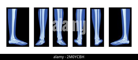 Set aus Röntgenfußbeinen Skeleton menschlicher Körper, Knochen Erwachsene Röntgen Vorderansicht der Rückseite. 3D realistisches, flaches blaues Farbkonzept Vektordarstellung der medizinischen Anatomie auf schwarzem Hintergrund isoliert Stock Vektor