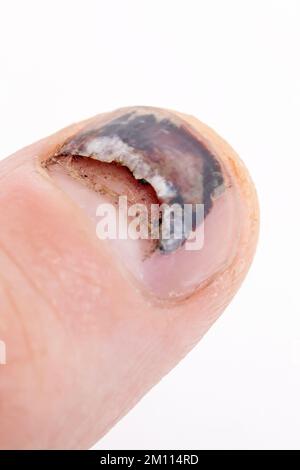 Der Nagel schält sich am Finger und der Prellung Stockfoto