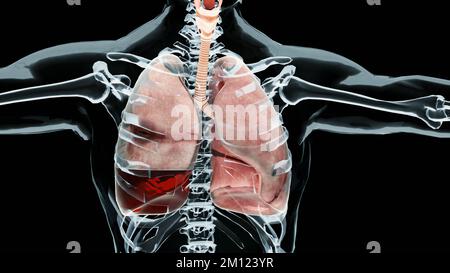 3D Illustration von Hämopneumothorax, normale Lunge versus kollabiert, Symptome von Hämopneumothorax, Pleuraerguss, Empyem, Komplikationen nach a ches Stockfoto